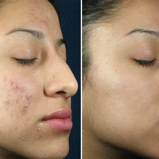 INCREDIBLY CLEAR ACNE SPOT